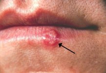 Herpes(PHIL_1573_lores).jpg