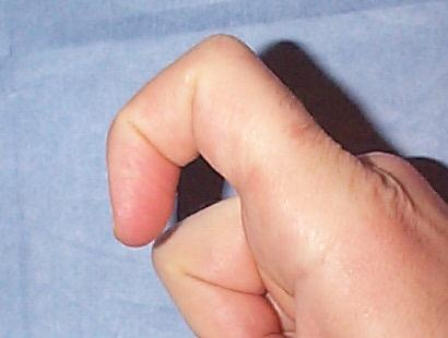 trigger_finger_2_medium.jpg
