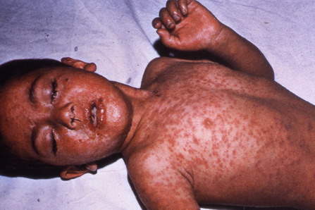 measles_1.jpg