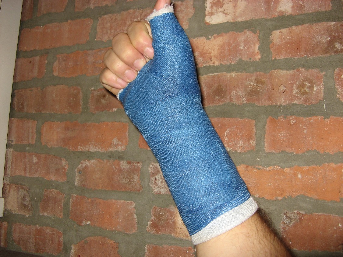 broken-wrist-blue-cast.jpg