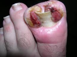nasty+toe.jpg